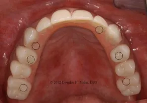 A close up of teeth with several different types of dental implants.