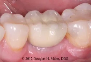A close up of the teeth with porcelain crowns.