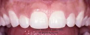 A close up of the teeth with pink and white fillings