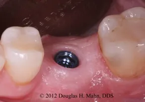 A close up of the tooth with an implant in it