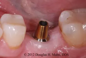 A close up of the tooth implant in someone 's mouth