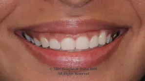 A close up of the teeth of a woman smiling.