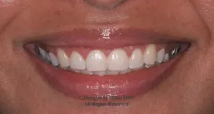 A close up of the teeth and smile of a woman