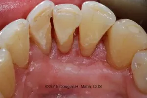 A close up of teeth with missing tooth and plaque.