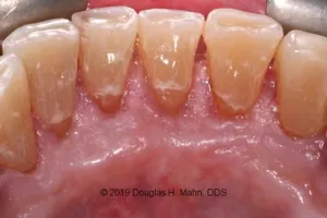 A close up of teeth with porcelain crowns