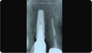 A x-ray of the back end of a bottle.