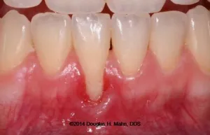 A close up of the teeth with gingivitis