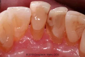 A close up of teeth with tooth decay