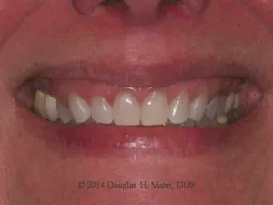 A close up of the teeth and smile of a person