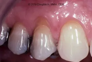 A close up of the teeth with porcelain fillings