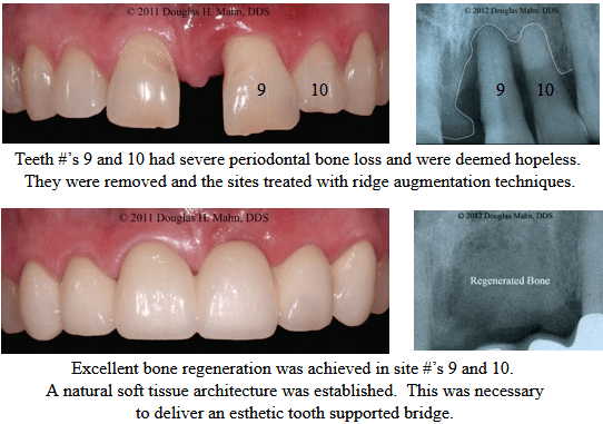 A picture of the same teeth before and after dental treatment.