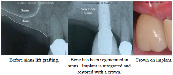 A picture of an x-ray showing the new bone in sinus.