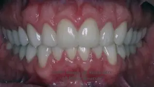 A close up of teeth with white teeth