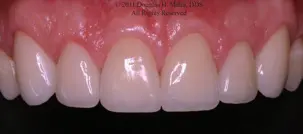 A close up of the teeth with porcelain veneers.