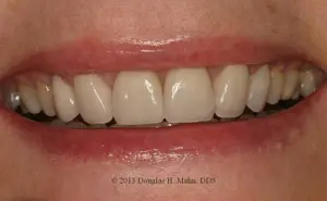A close up of the teeth with white teeth