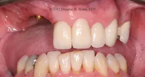 A close up of teeth with missing tooth and dental implants