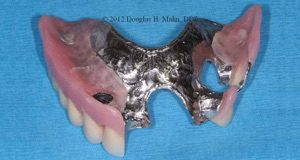 A metal casting of the upper part of an artificial tooth.