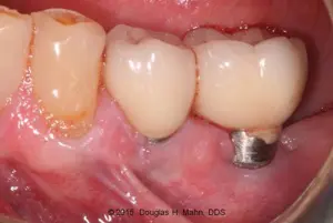 A close up of an implant in the lower part of a tooth.