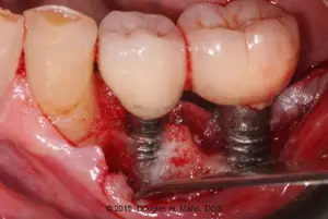 A close up of an implant in the lower jaw