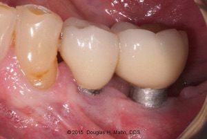 A close up of an implant retained tooth