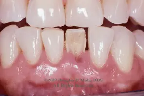 A close up of teeth with tooth decay
