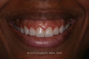 A close up of the teeth and smile of a person.