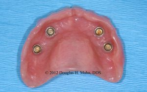 A picture of an implant retained denture.