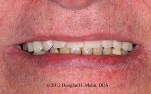 A man 's teeth are shown with white spots.