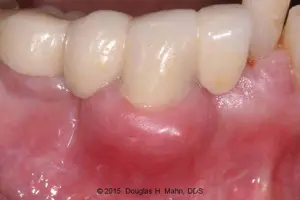 A close up of the teeth and gums