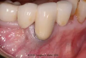A close up of the teeth and gums