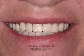 A close up of the teeth of someone with white teeth