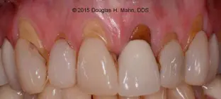 A close up of the teeth with tooth decay