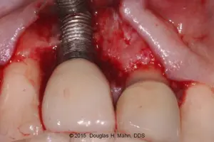 A close up of an implant in the mouth