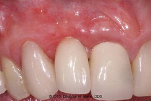 A close up of teeth with missing tooth and gum disease