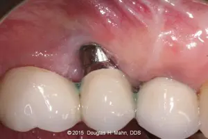 A close up of an implant in the lower part of a tooth.