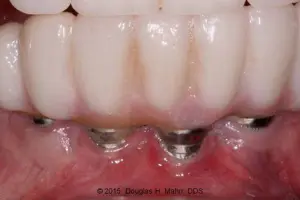 A close up of an implant supported bridge