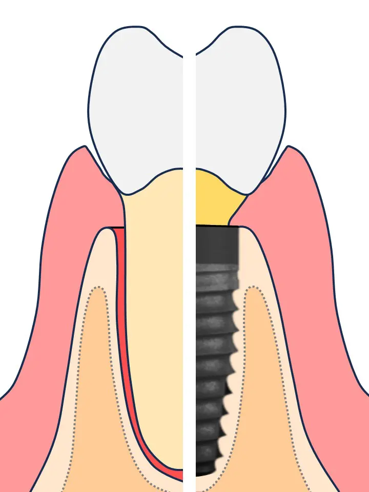 A tooth implant is being placed in the lower jaw.